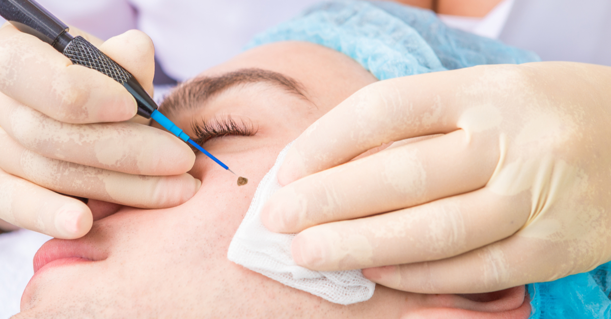 طرق التخلص من الشامات