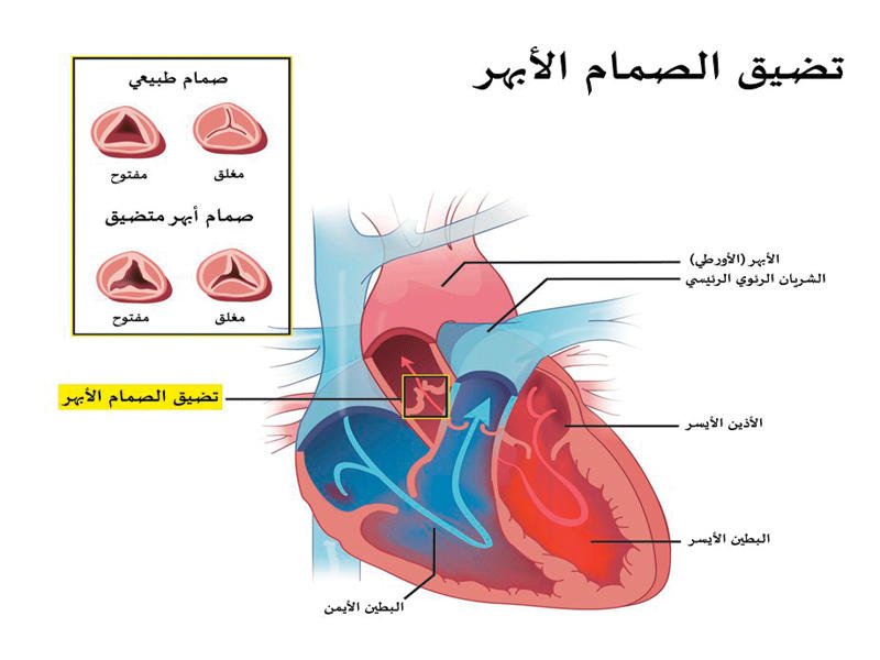 تضييق الصمام الأبهري