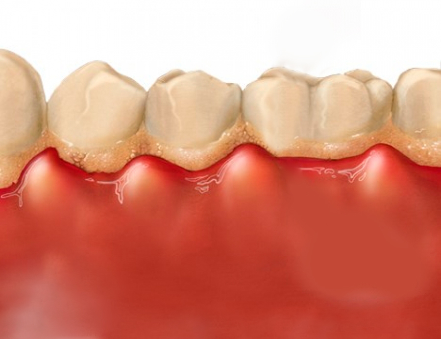 ماذا يعني وجود إلتهاب في اللثة وما هي أعراضه؟
