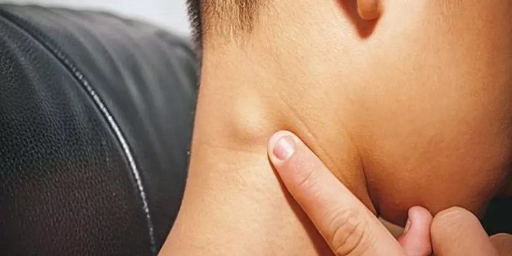 سرطان الغدة اللمفاوية