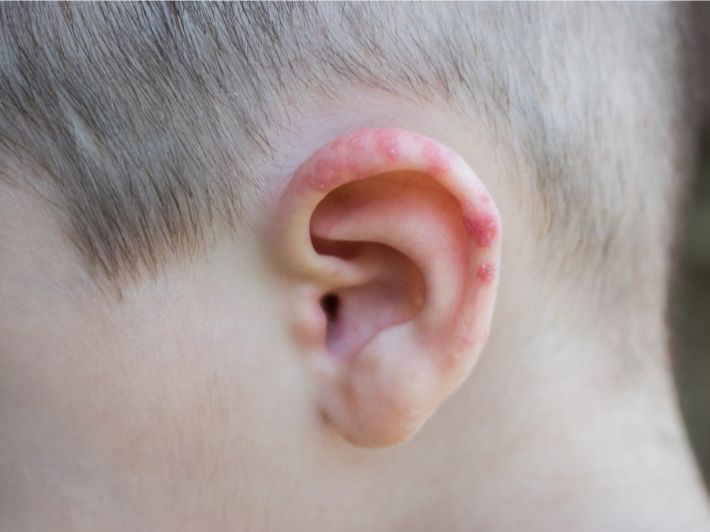 التهاب الأذن الشامل