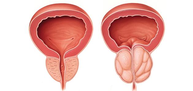 تضخم البروستاتا