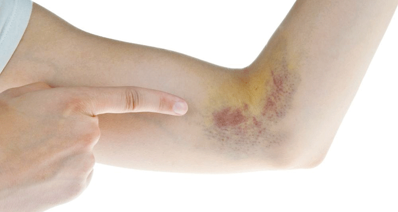 لماذا يتعرض جسمنا للنزيف