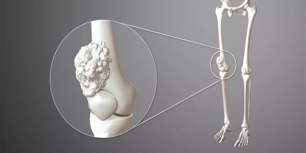 سرطان العظام