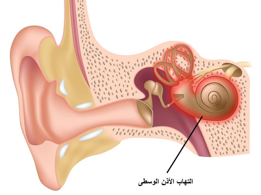 الفرق بين إلتهاب الأذن الداخلية وإلتهاب الأذن الوسطى